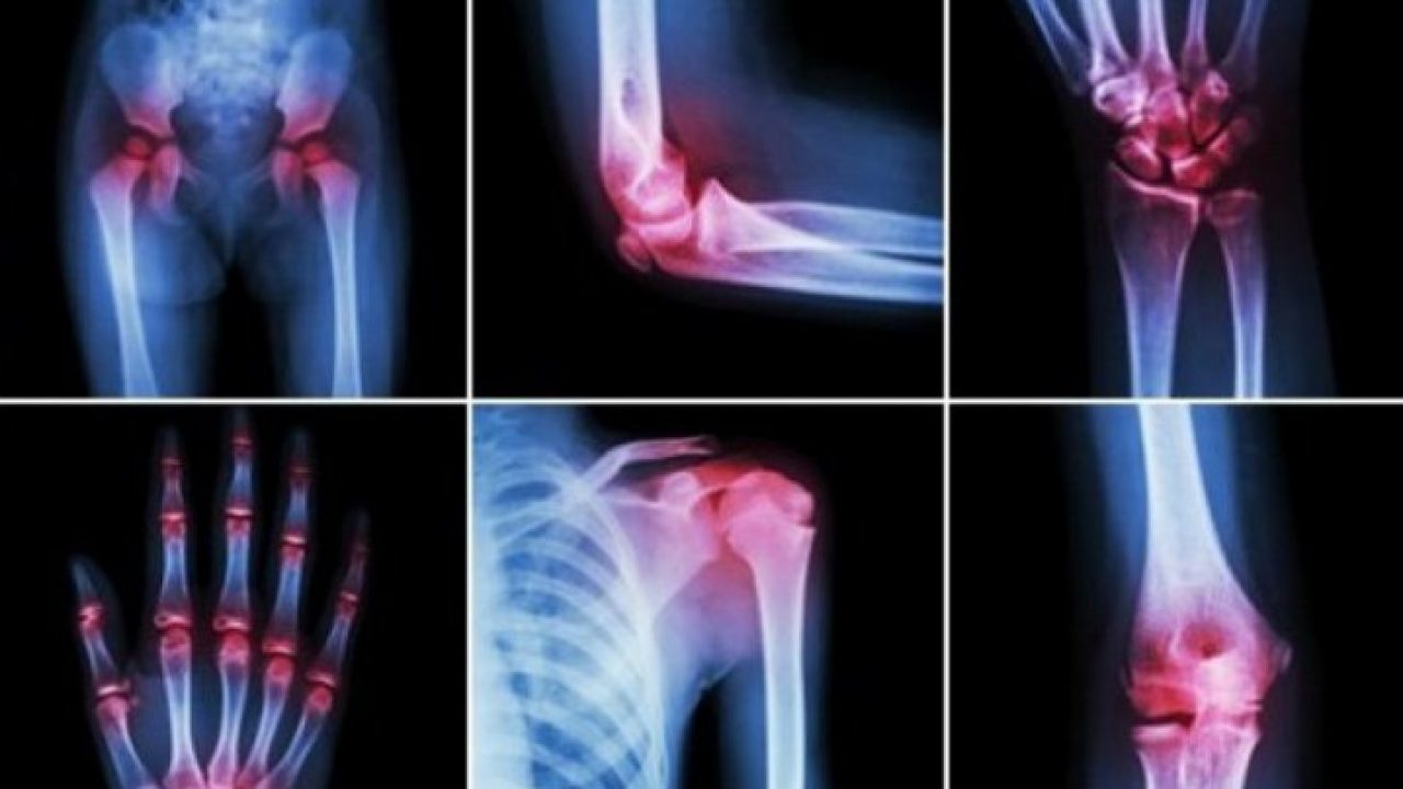 artrita de medicină comună edem cu bursita articulației genunchiului